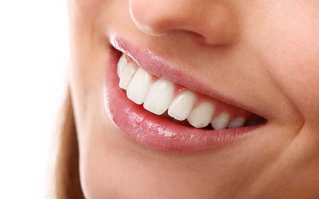 Laminate Veneers