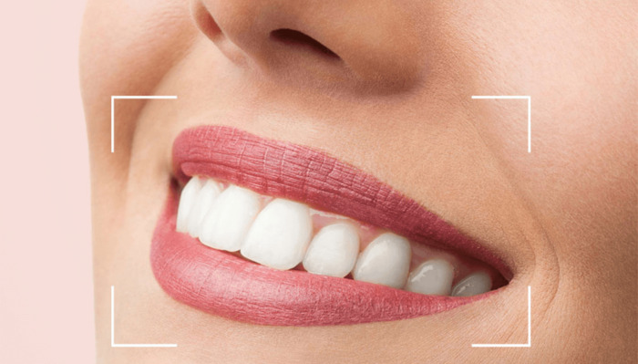Dental Crowns